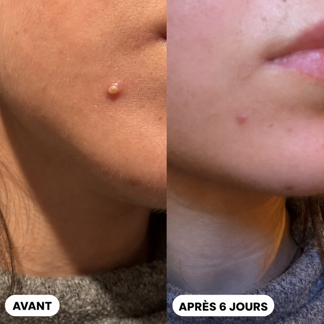 Patch Anti-Boutons Hydrocolloïde — Jour & Nuit